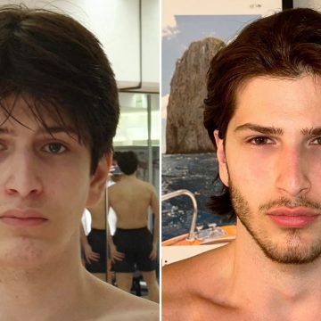 Hoe ‘looksmaxxing’ het gezicht van jonge mannen verandert